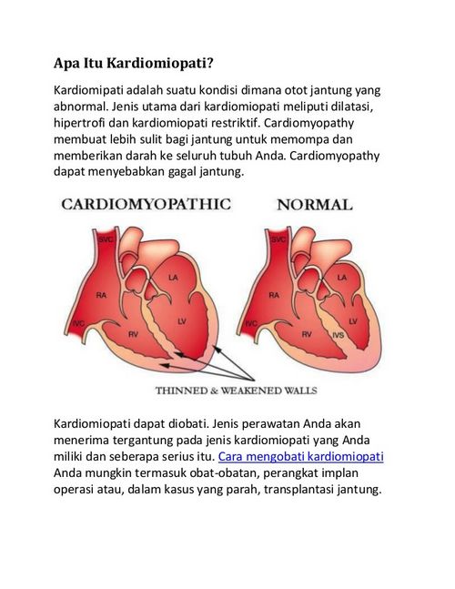 Apa Itu Kardiomiopati Dilatasi? pada lengan dan tungkai